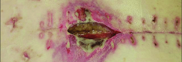 Chirurgická infekcia – prevencia a liečba