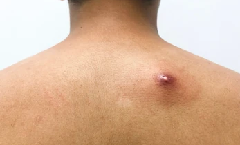 Flegmóna a absces