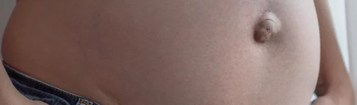 Umbilikálna hernia, hernia v linea alba, hernia v jazve