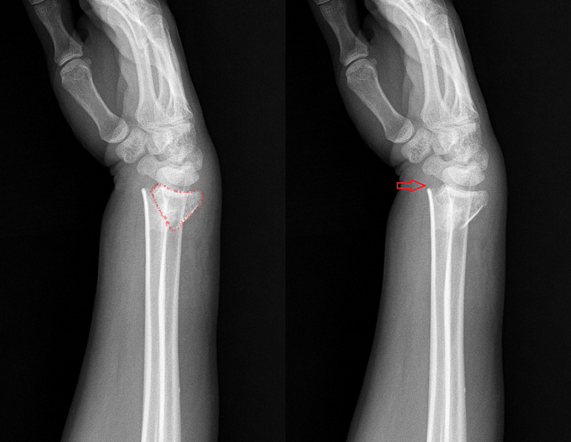 Zlomeniny predlaktia a zápästia - Medicína a chirurgia