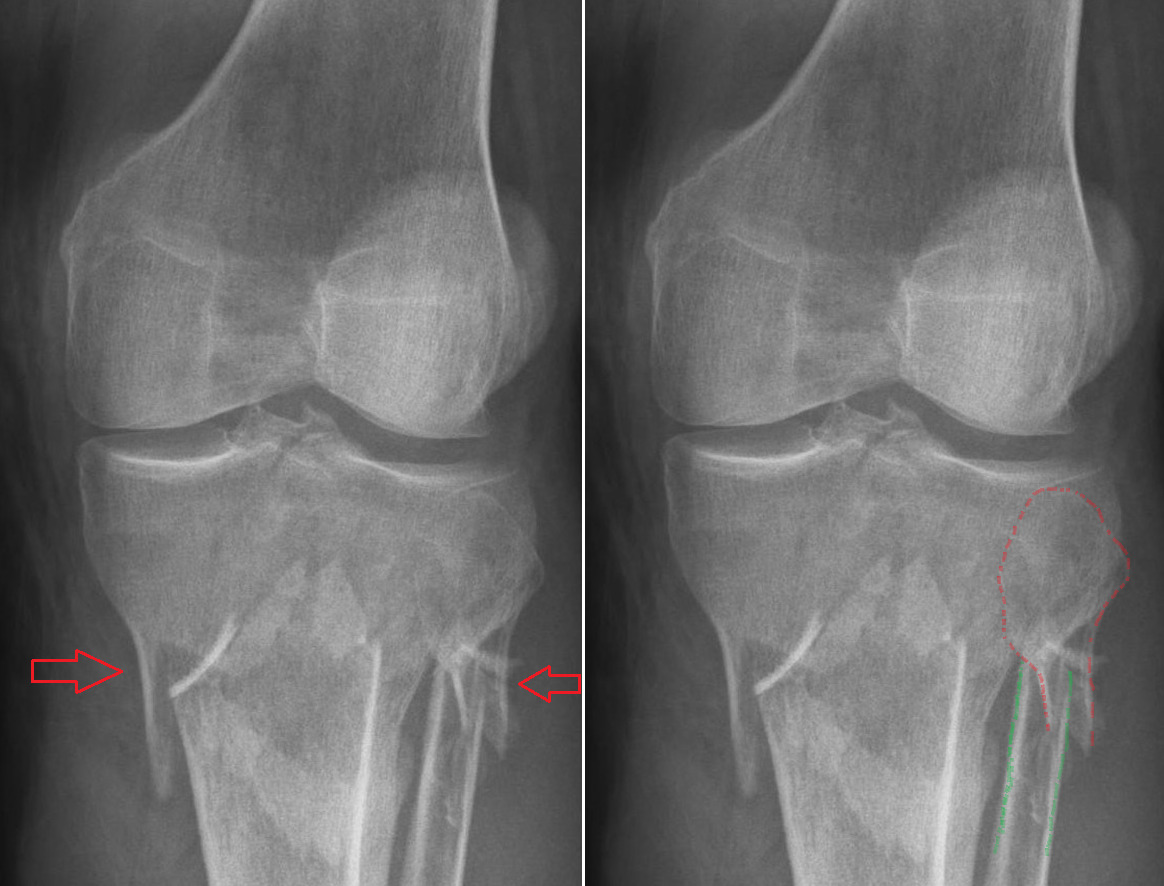 Zlomeniny proximálnej tíbie a fibuly - Medicína a chirurgia