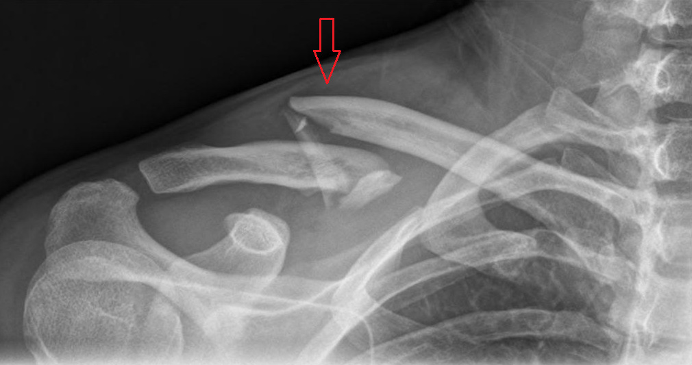 Zlomeniny kľúčnej kosti - Medicína a chirurgia